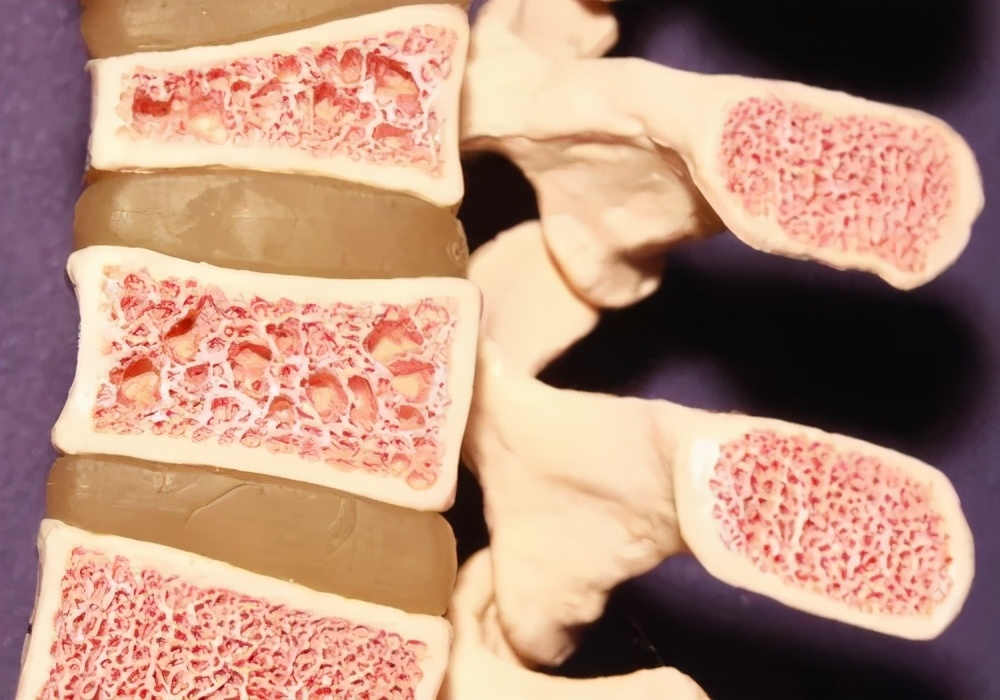 更年期骨质疏松如何预防和治疗?