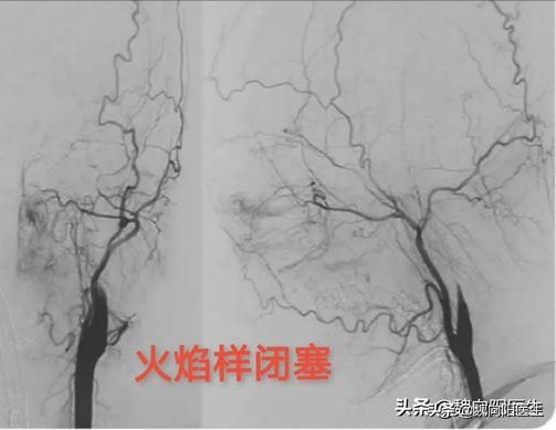 颈动脉闭塞血管夹层,颈动脉夹层是什么原因形成的