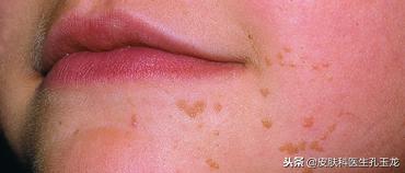 皮肤科疣有哪些,最常见的皮肤病扁平疣