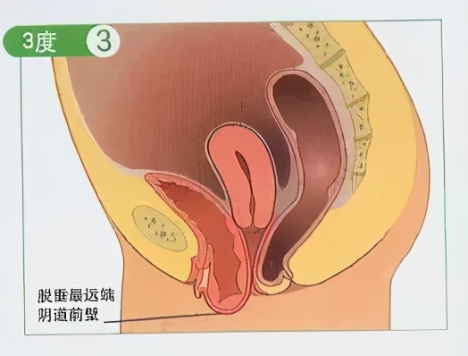 产后子宫轻度脱垂的人多吗,产后子宫脱垂和阴道壁膨出症状