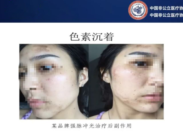 打完玻尿酸和瘦脸针的注意事项,打完玻尿酸和瘦脸针应该注意什么