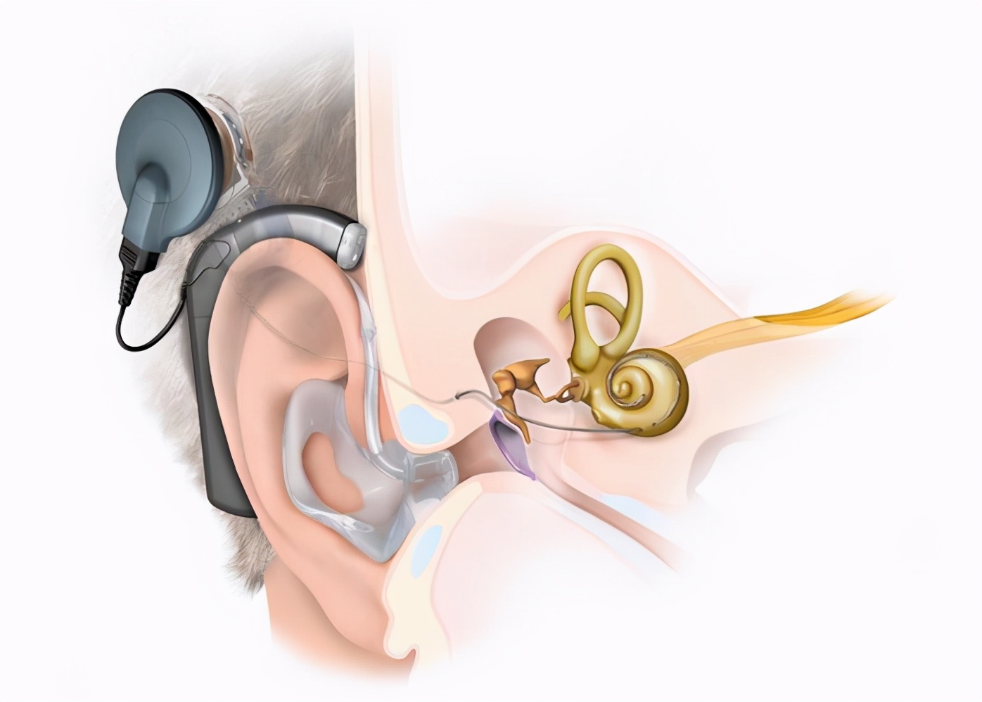 人工耳蜗可以帮助恢复正常听力吗,耳蜗对听障人士的帮助