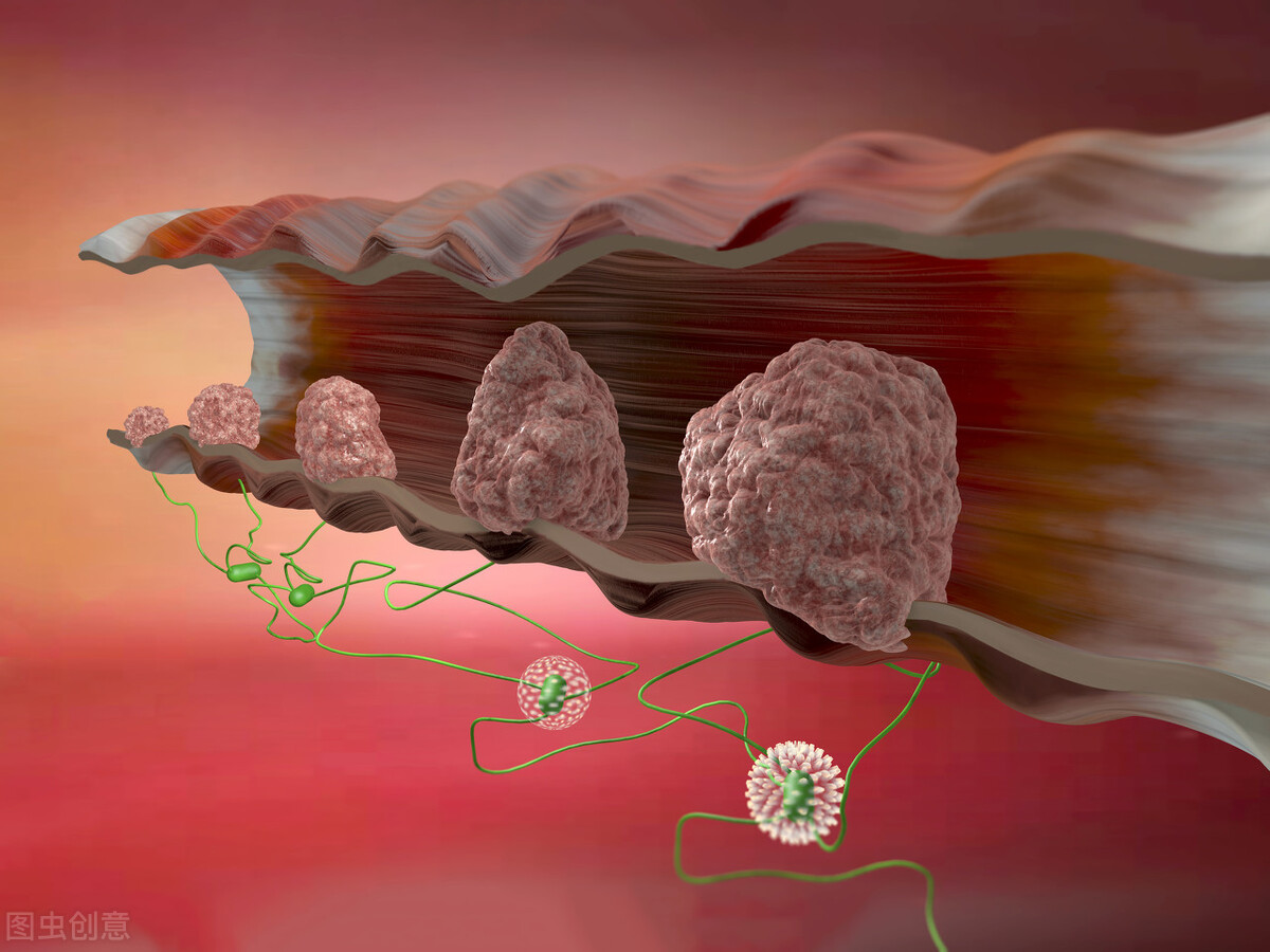 结直肠癌转移有半月能治好吗,结直肠癌转移肺能活多久