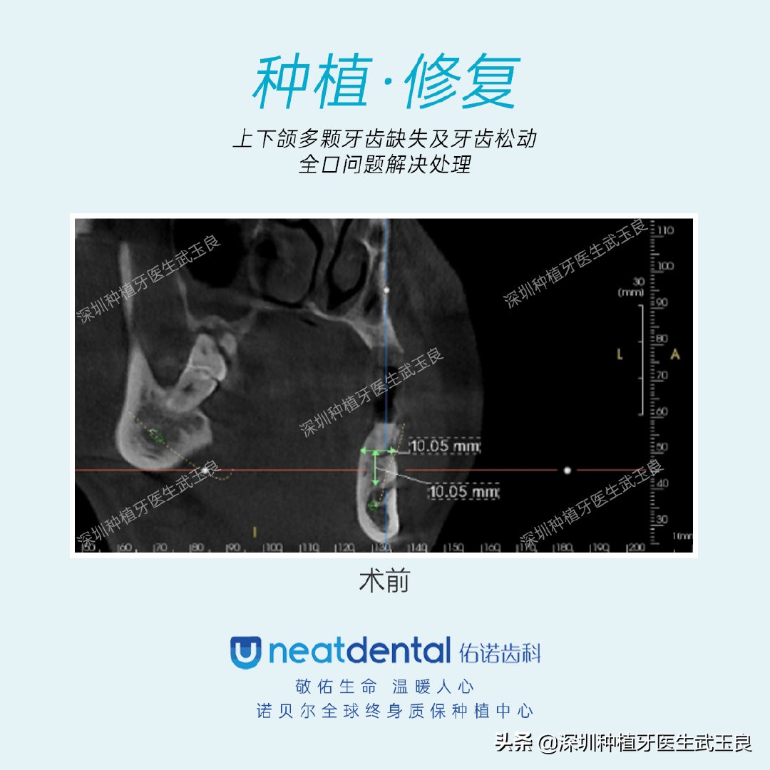 多颗牙齿缺失怎么修复全过程,多颗缺失牙修复案例