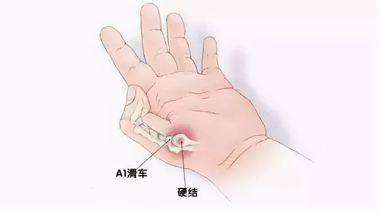 你的孩子会点赞吗？带你了解“扳机指”