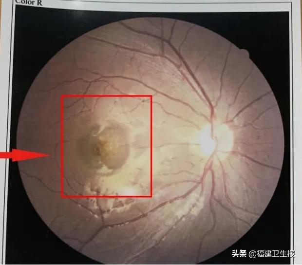 7宀佺敺瀛╁彸鐪艰鐑т激,7宀佺敺瀛╃溂鐫涜鐑т激