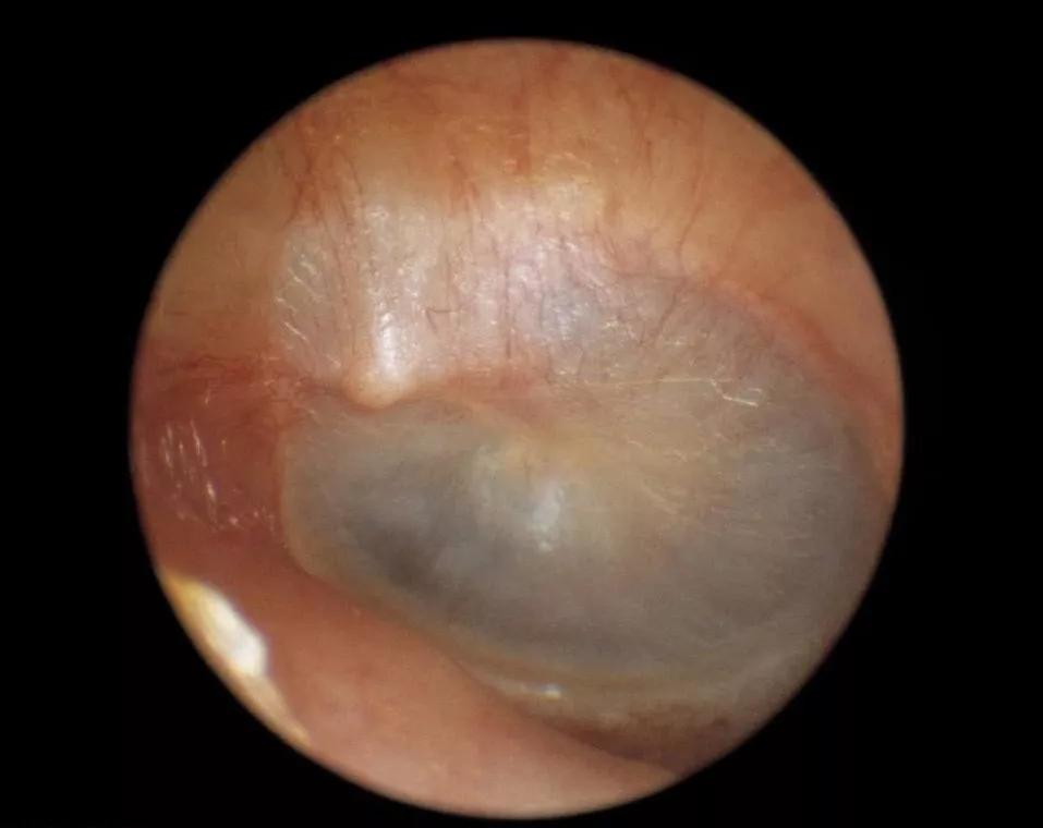 耳朵流脓听力下降耳鸣,耳朵反复流脓听力下降需要手术吗