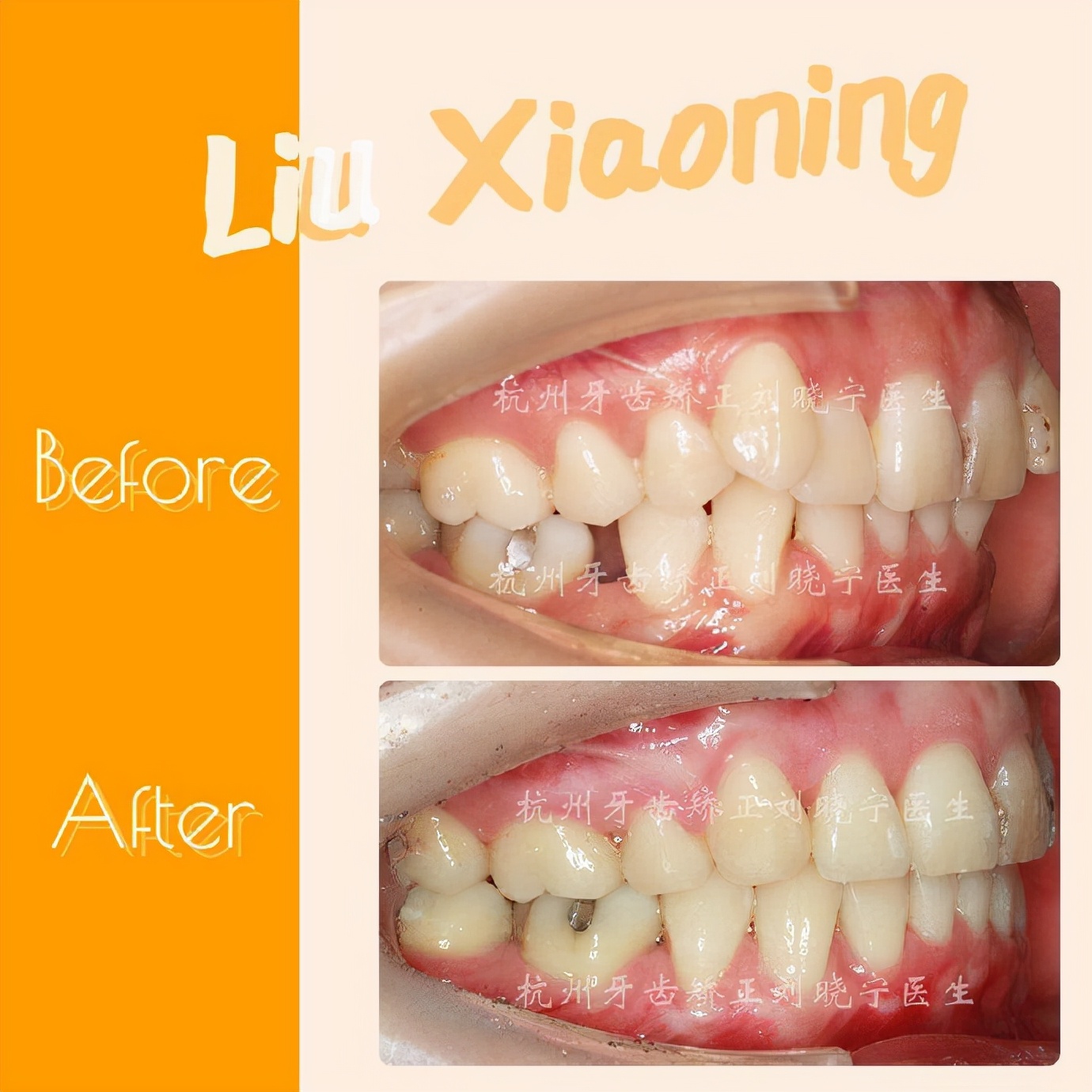 杭州舌侧牙齿矫正,舌侧矫正杭州价格