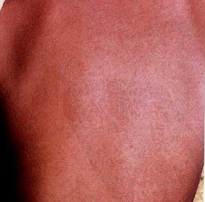 孩子喉咙痛低烧然后身上起疹子,小孩喉咙痛有小颗粒身上出疹