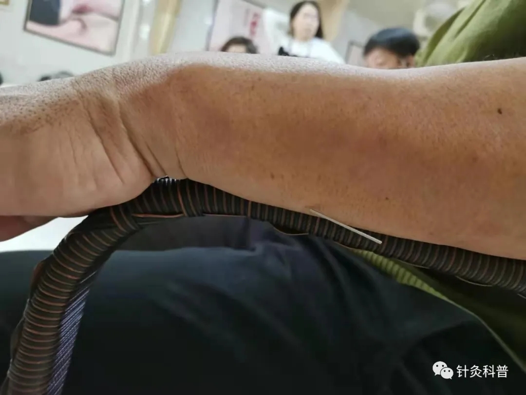 肩背痛一针针灸法,针灸治疗颈肩腰腿痛