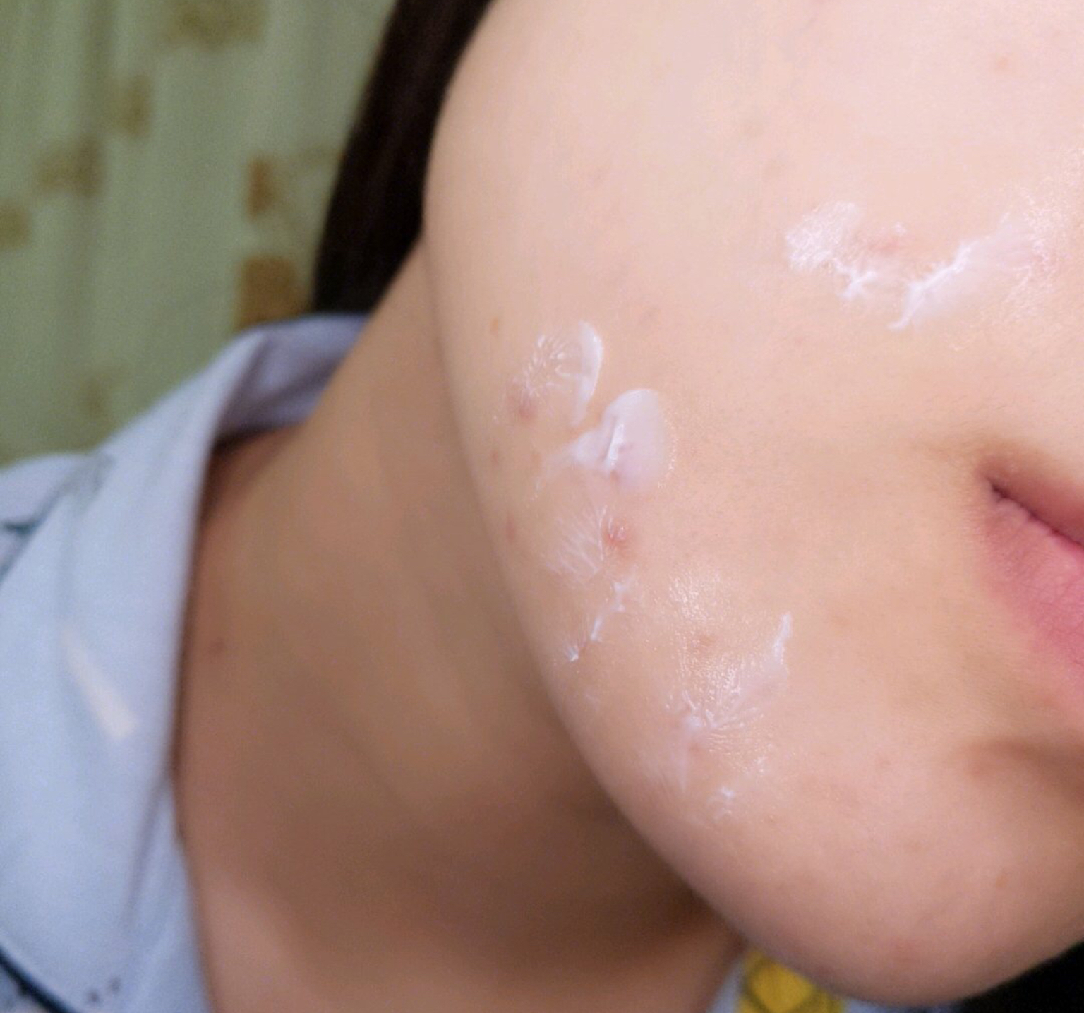 热门的祛痘精华,热门祛痘精华功效与作用