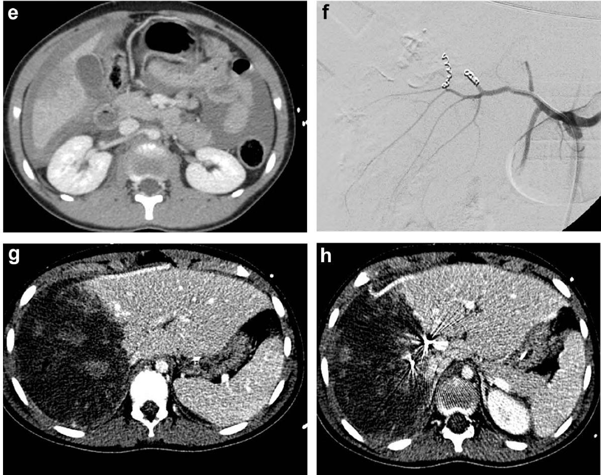 肝脏损伤的诊断和处理,肝脏损伤ii级
