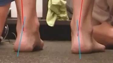 什么是扁平足？日常生活要怎样预防呢？