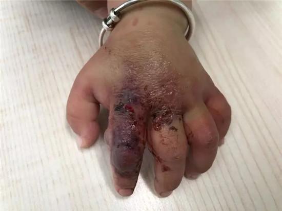 一岁多宝宝手肿得跟馒头一样,13岁小孩手肿的像馒头怎么回事