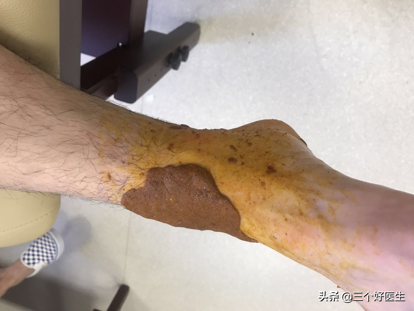 踝关节扭伤肿胀有瘀血需要弄破吗,踝关节扭伤软组织肿胀处理原则