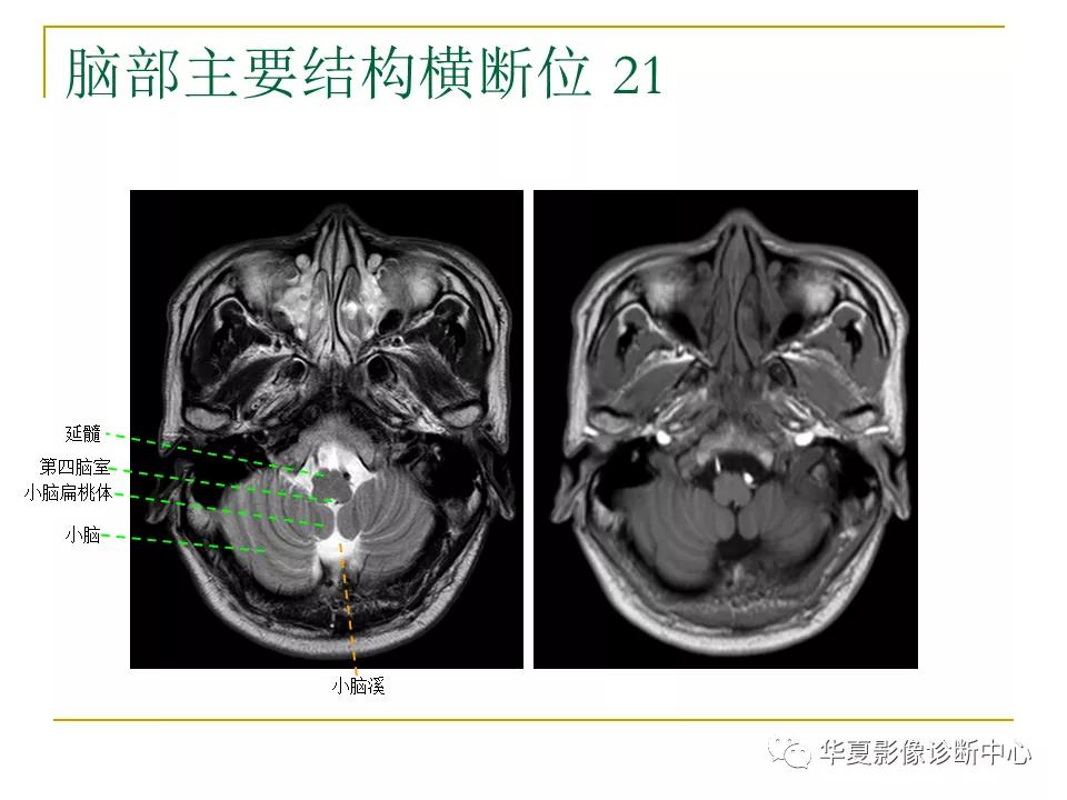 中国人脑立体定向mri应用解剖图谱,脑mri示意图