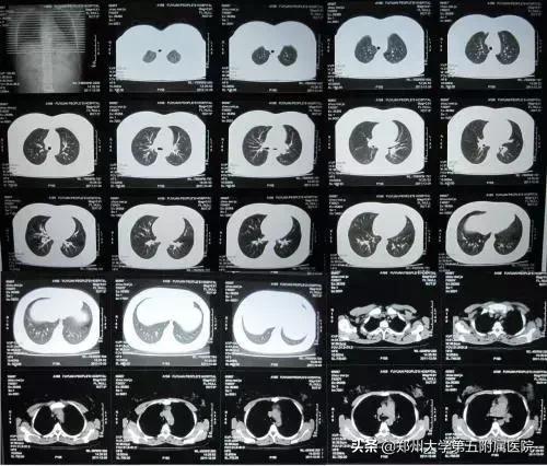ct胶片的种类,ct胶片有利用价值吗