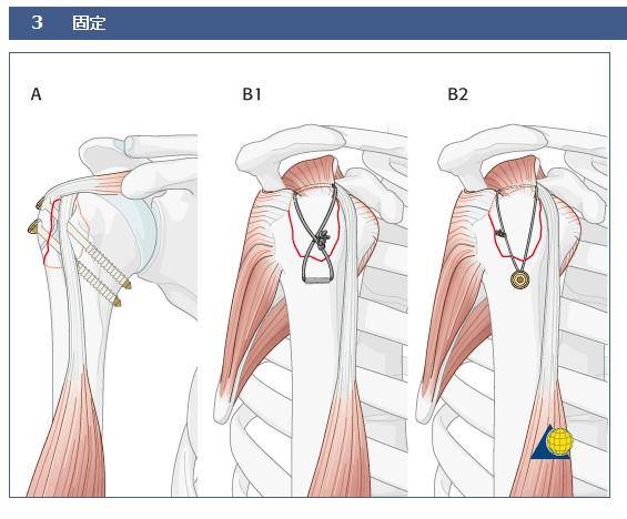 如何学习骨科康复治疗,骨科科普宣教小知识