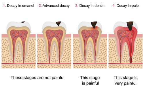 5岁10个龋齿,5岁孩子6颗龋齿