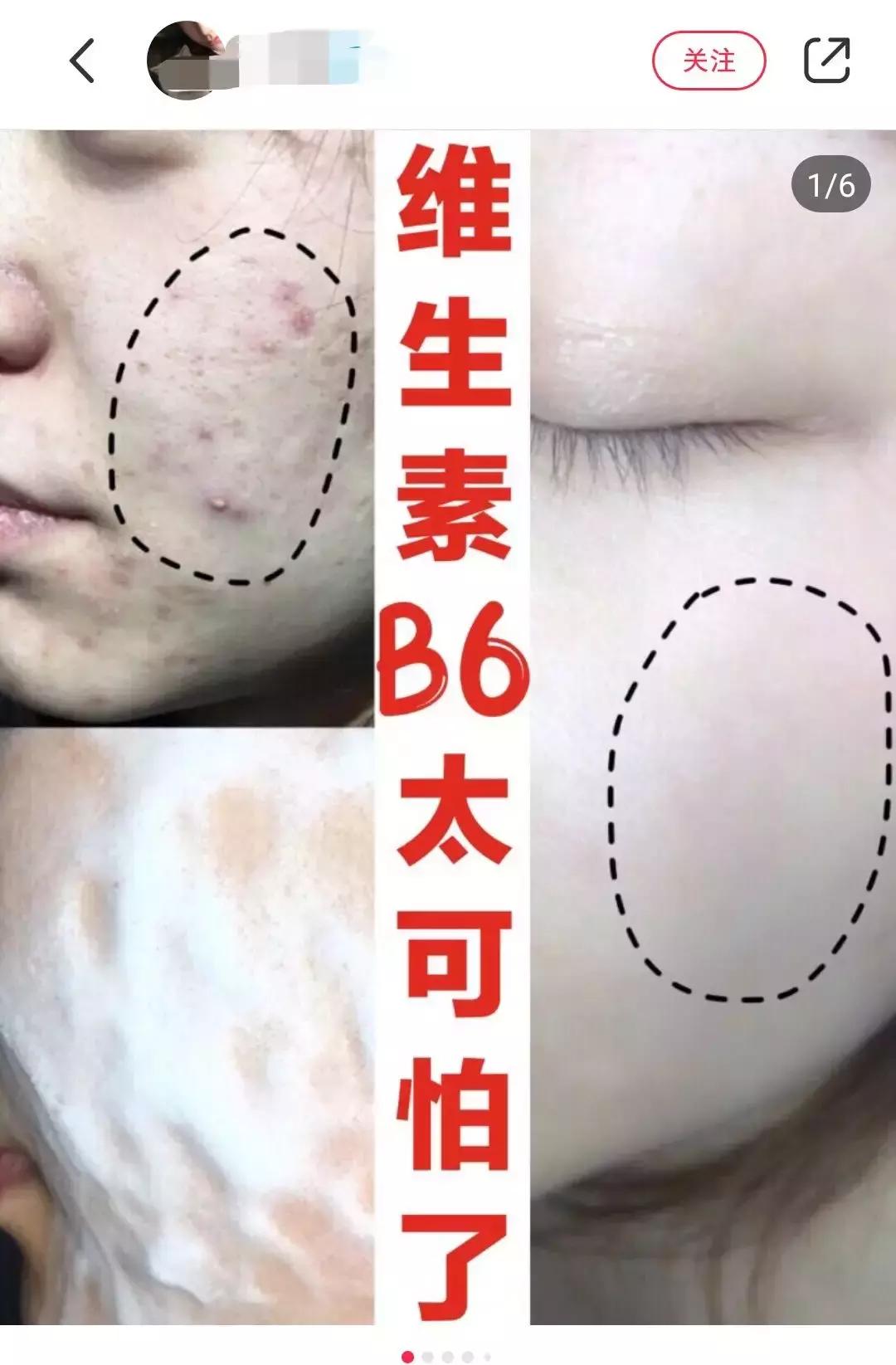 外用维生素e软胶囊的作用,维生素e外用的功效与作用