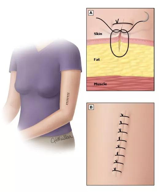 伤口美容缝合跟普通缝合比较图,皮肤缝合的手法