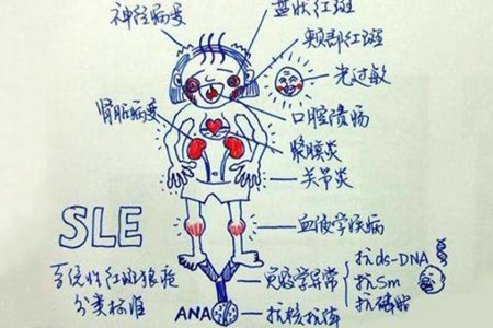 系统性红斑狼疮应该挂哪个科室,系统性红斑狼疮什么科室