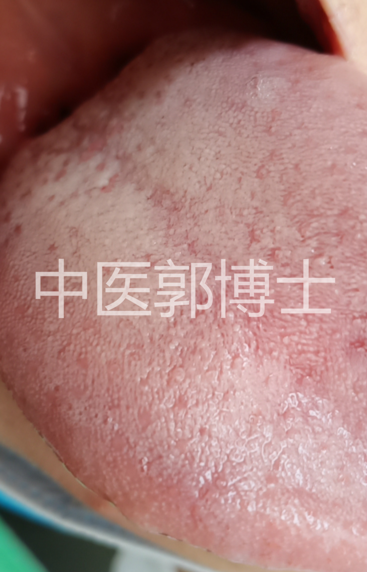 例假刚走1周，乳腺增生患者服药2天，白带又有血丝，药能继续吃吗