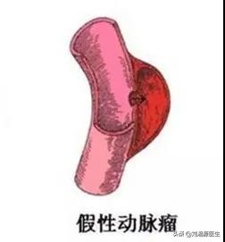 系统性血管炎怀孕能要吗,怀孕得了血管炎怎么办