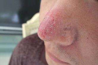 螨虫感染皮肤的症状用什么药,螨虫的最佳防治方法