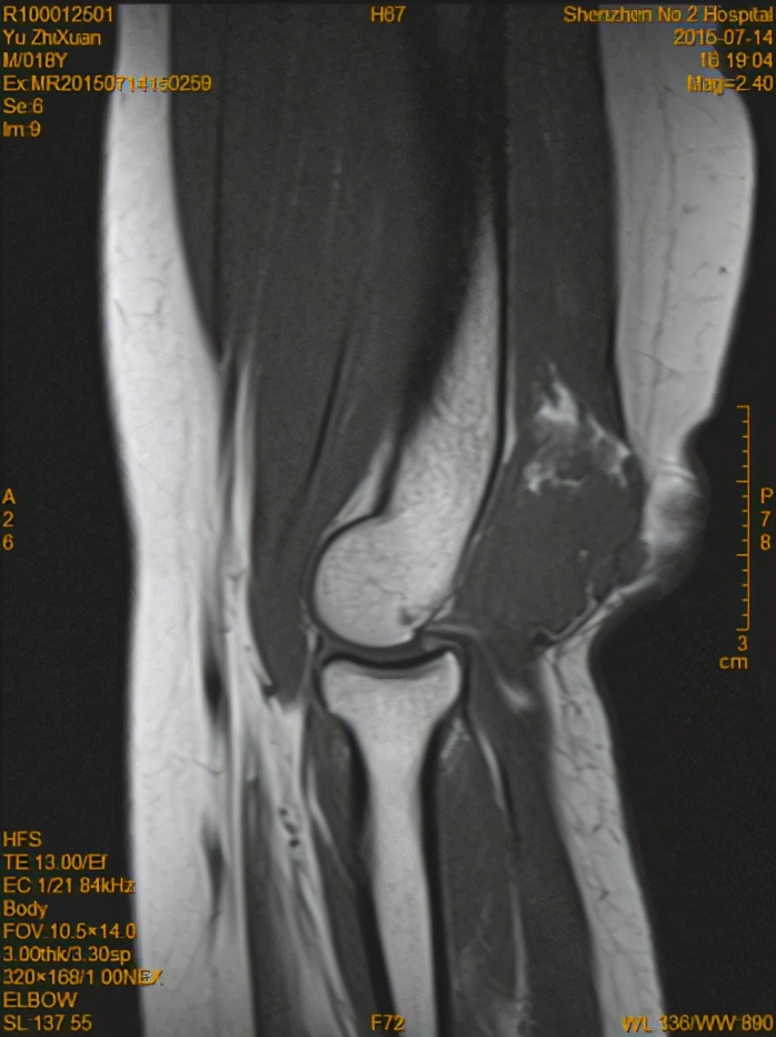 静脉畸形怎么办?介入栓塞是首选