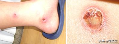 艾灸专家讲艾灸疗效,在家艾灸哪种灸法效果最好