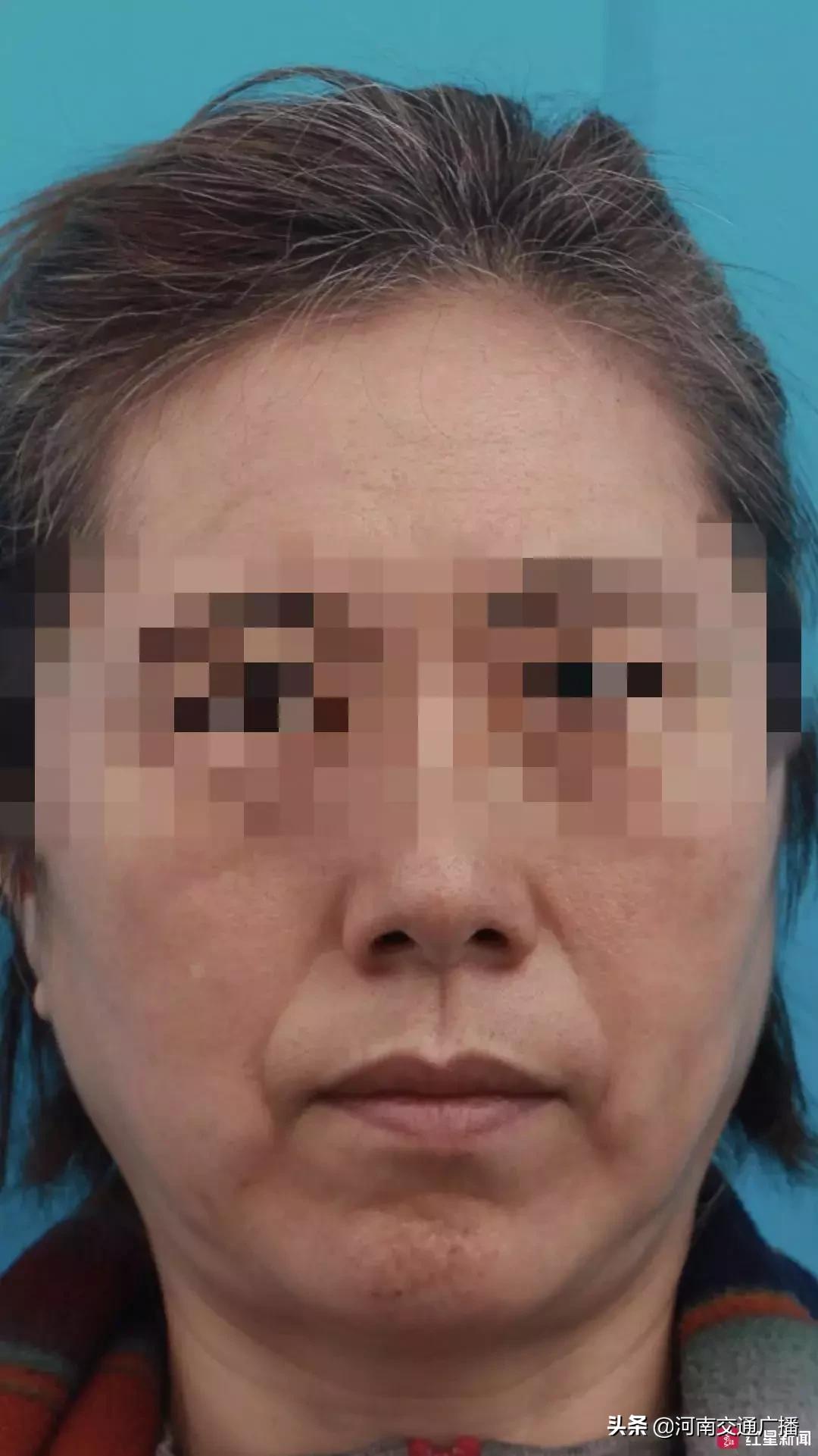 整形要谨慎女子整形失败上班被拒,女子花6万多整容后续