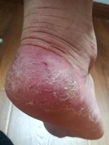 去角质灭真菌用什么,去角质最有效初学者