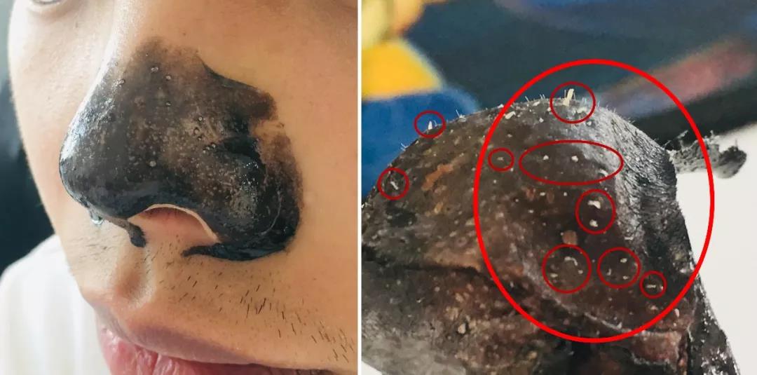 一秒去黑头去粉刺,一步就能搞定的黑头