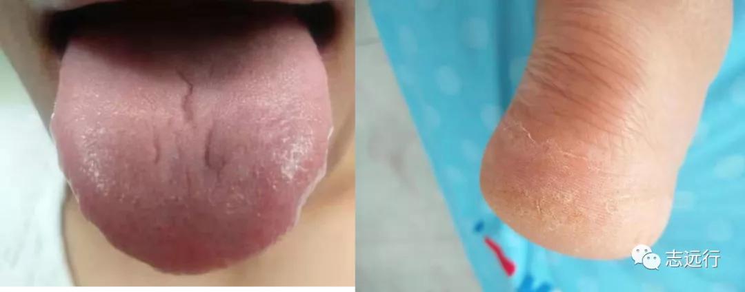 张景明治疗手足癣的中药方,一个治疗手足癣的好方子