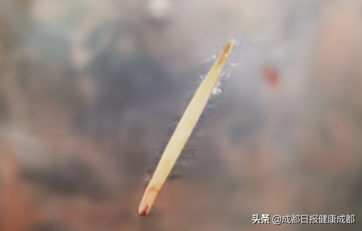 胃及十二指肠穿孔疼痛特点,胃病上腹疼痛