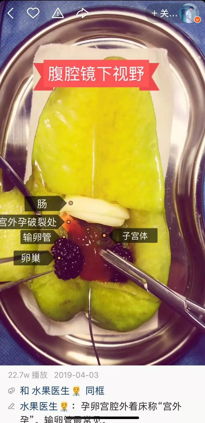 我在快手上看人切洋葱，竟然弄懂了剖腹产？