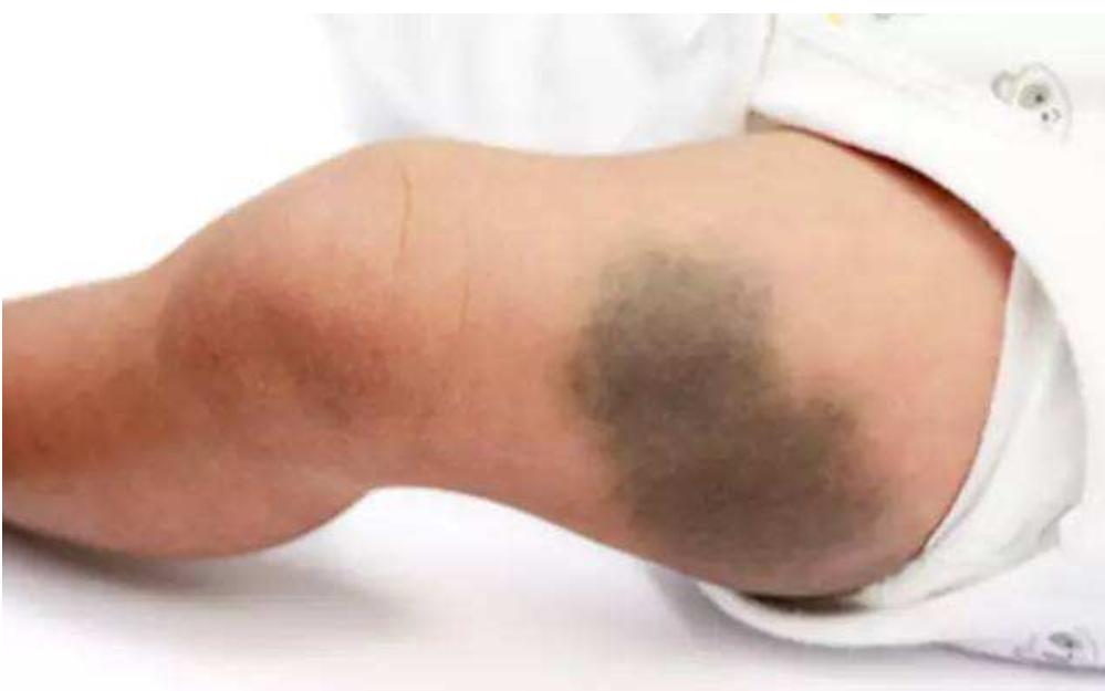 婴儿身上像有淤青一样的怎么回事,小婴儿身上有淤青是什么原因