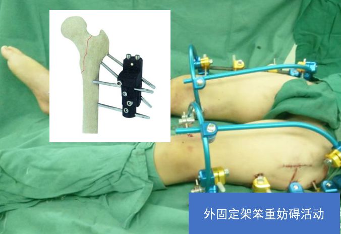 老人髋部骨折多长时间恢复到正常,老年人骨折无法固定怎么办