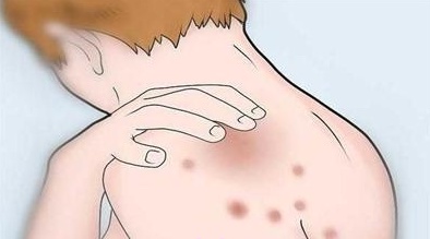 为什么总是长痘有什么办法,为什么背后这么多痘