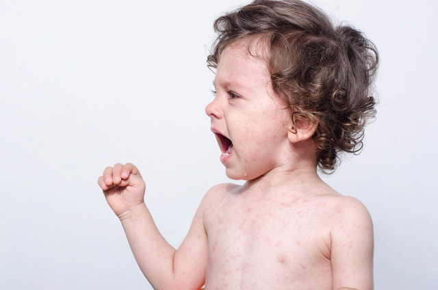 孩子夏季起痱子的处理方法,夏天天气炎热小孩容易长痱子