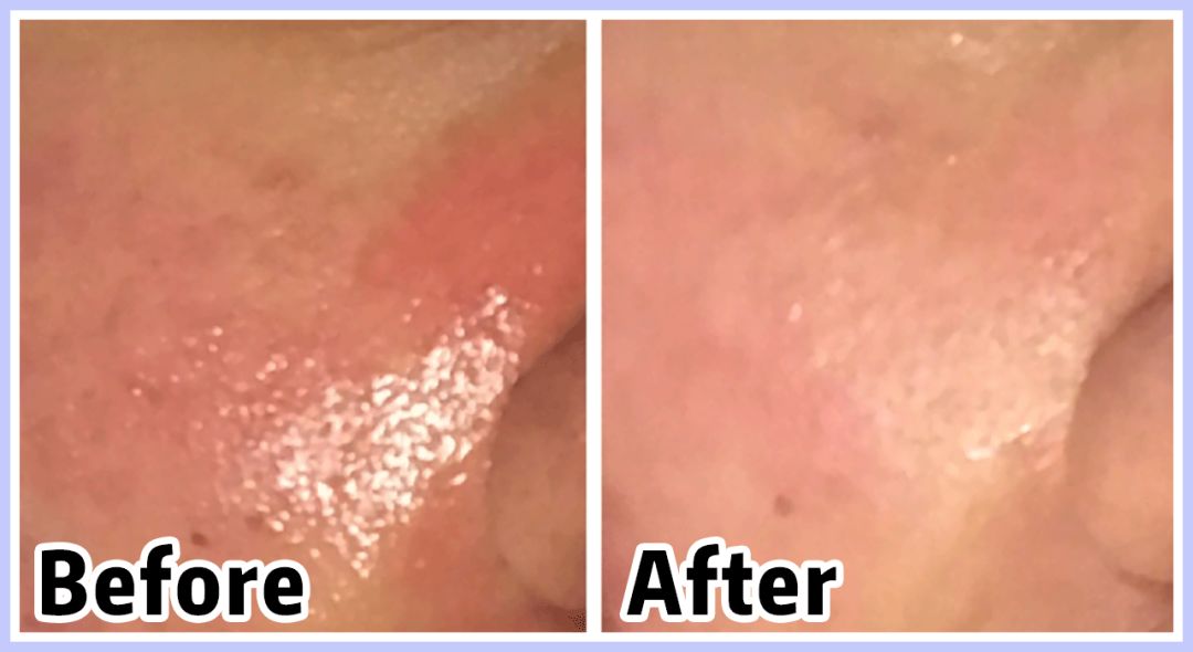 痘印痘坑目前治疗方法哪个最好,医美机构靠药物去痘印痘坑可靠吗