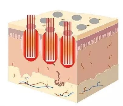 点阵激光打到正常皮肤会怎么样,激光点阵能给皮肤带来什么效果