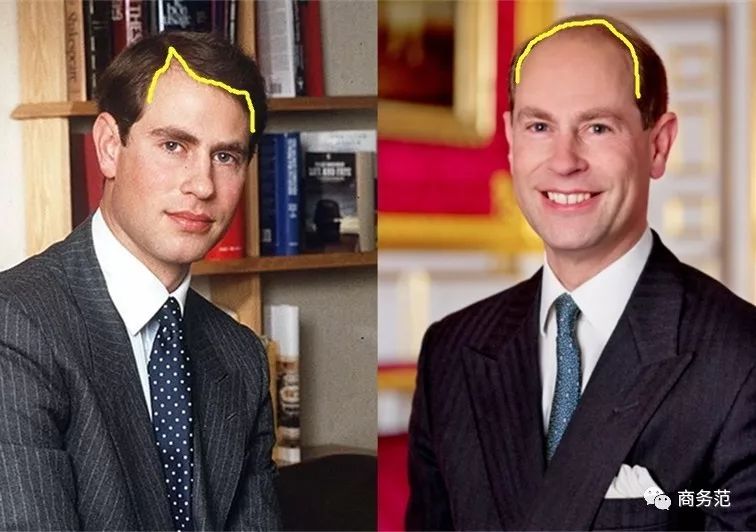 威廉王子秃顶了哈里为啥没秃顶,威廉王子为什么喜欢秃顶