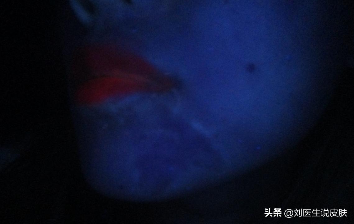 23岁女孩白癜风怎么治疗,29岁女人白癜风自愈