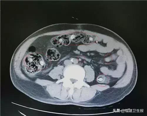 千万不要这样吃杨梅！漳州一老汉已中招，后果很严重...