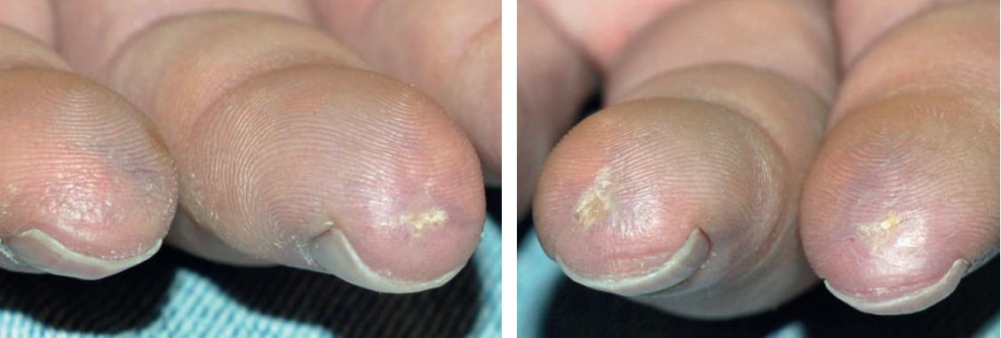 系统性硬化症/硬皮病是什么样的疾病?