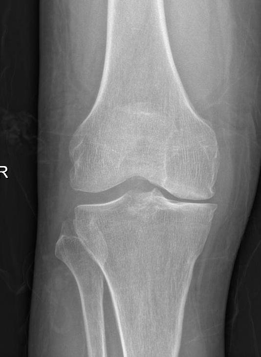 膝关节阶梯治疗ppt,膝关节骨性关节炎阶梯化治疗
