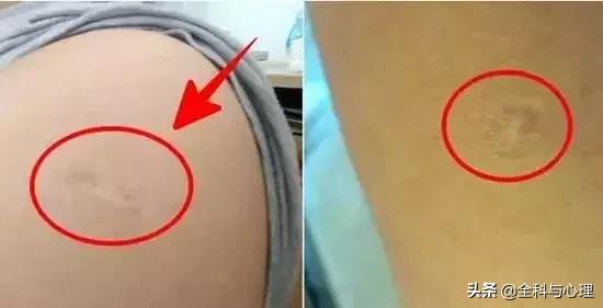 胳膊上莫名其妙的长疤怎么来的,胳膊上的疤是怎么来的