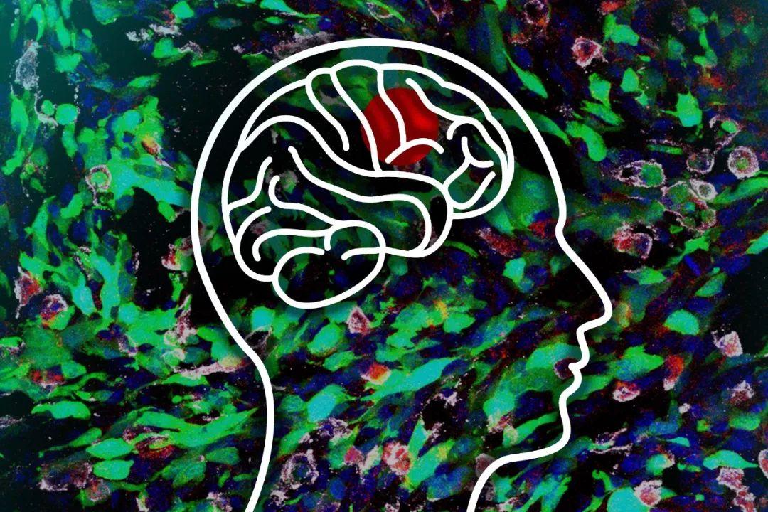 额叶肿瘤有什么特征,少突胶质细胞瘤多发于额叶